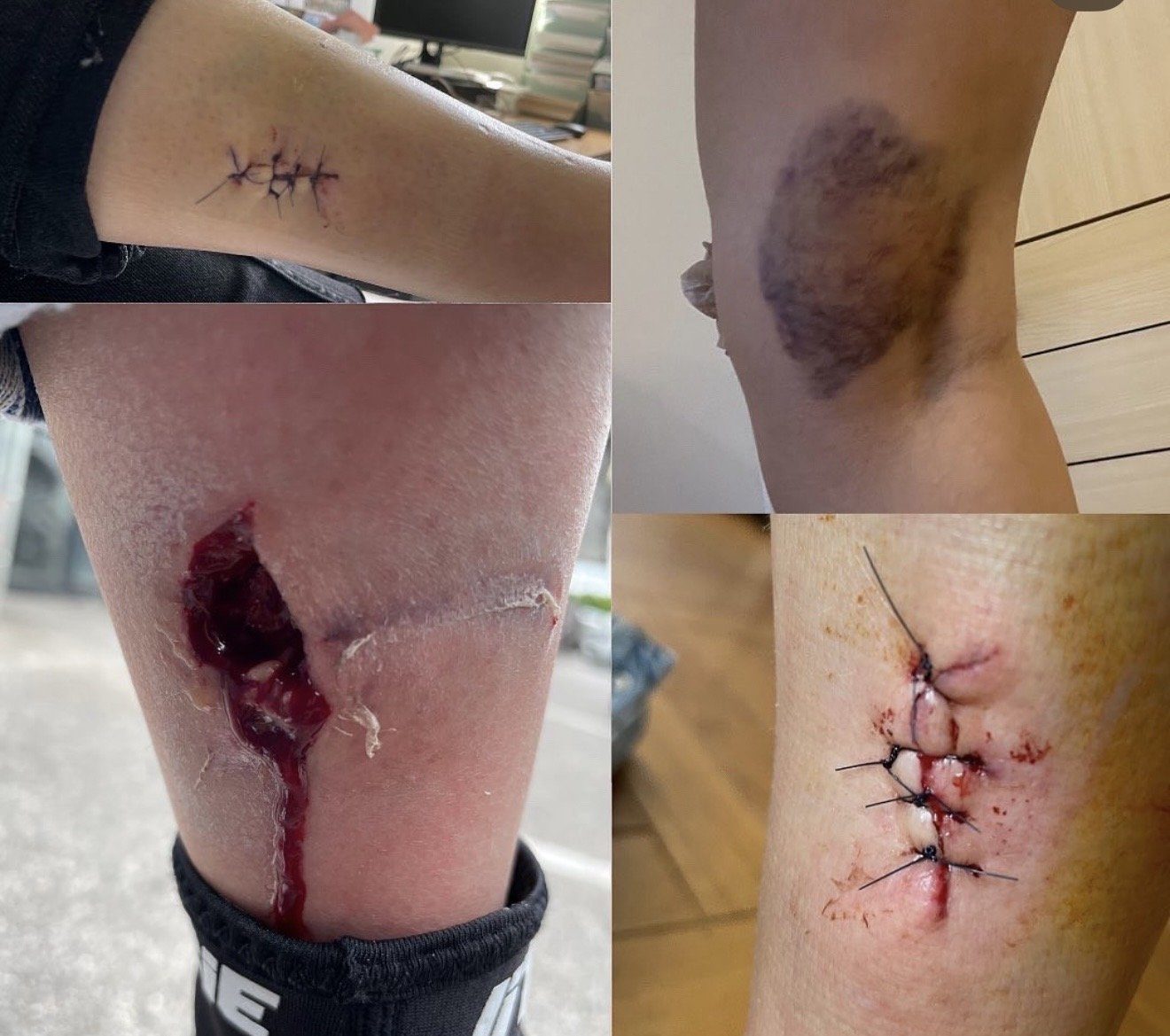 Blessures : points de suture, hématome et plaie